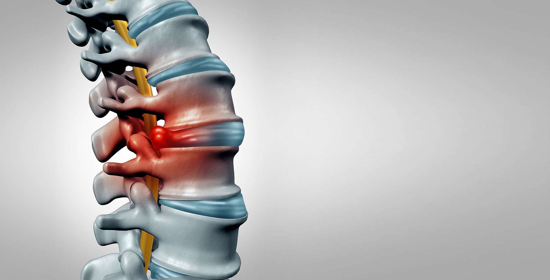 Neck And Back Pain Relief Without Surgery